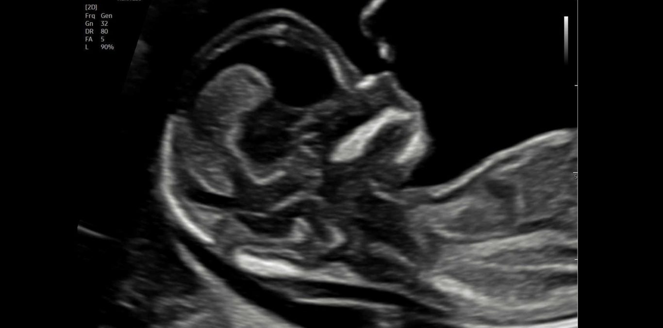 Das Profilbild ermöglicht die Darstellung der Nackentransparenz.