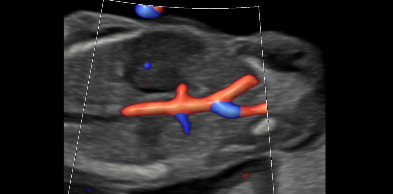 Die Nierengefäße sind bereits darstellbar.