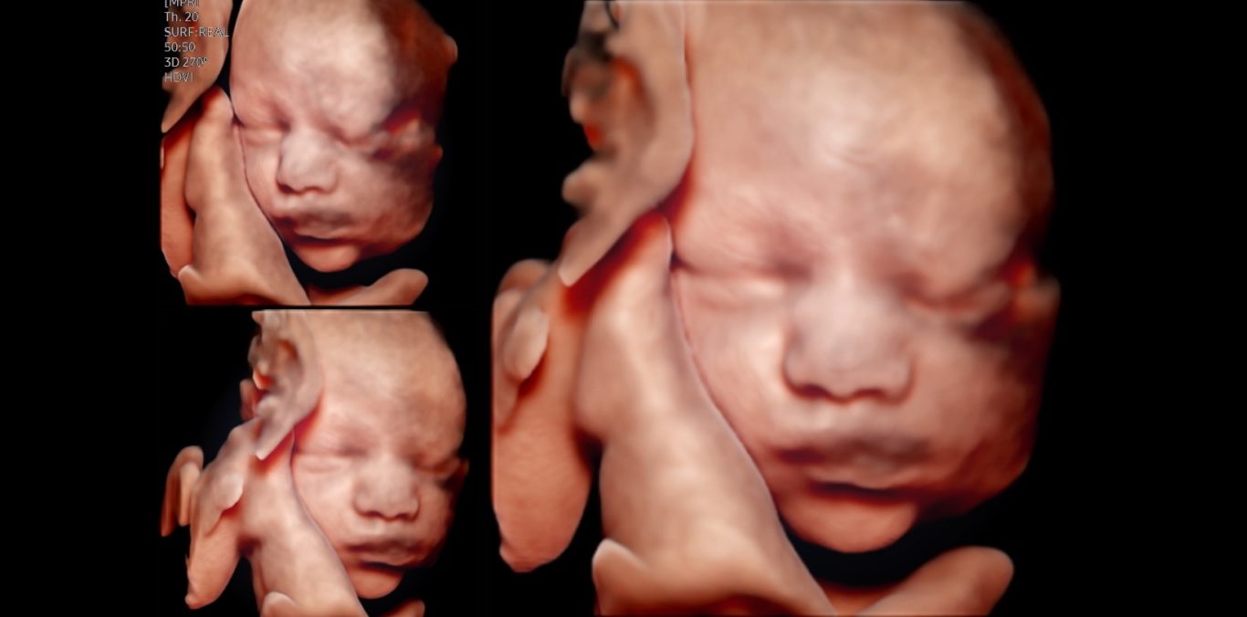 In der Frontalaufnahme (hier 32 SSW) sind die geschlossenen Lippen und normalen Lidachsen gut erkennbar.