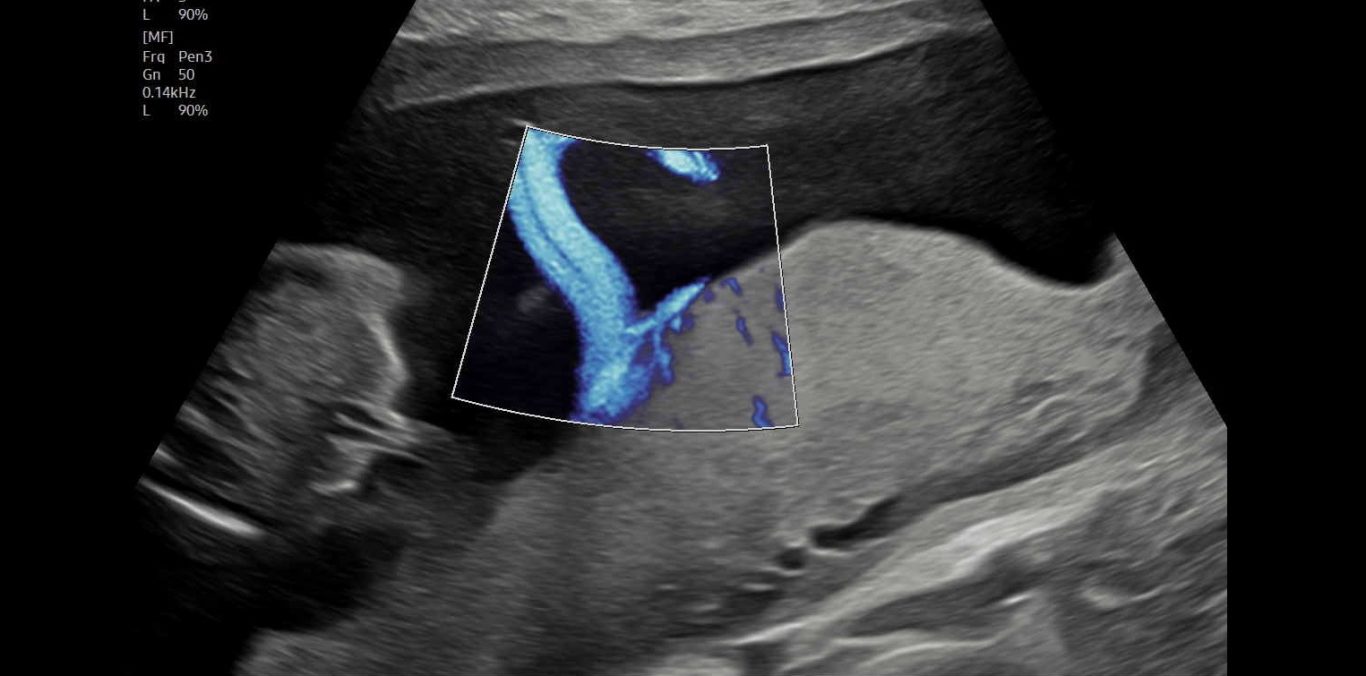 Wir sehen die Lage von Mutterkuchen und den Nabelschnuransatz.
